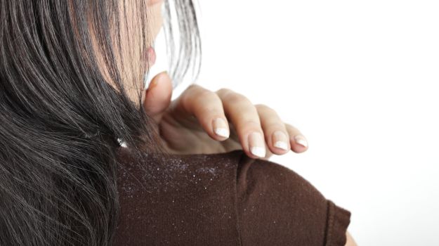 7 Easy Home Remedies to Get Rid of Dandruff