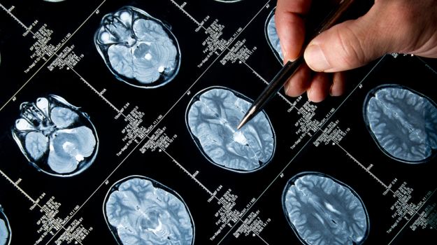 Decreased Blood Flow in Brain Earliest Sign of Alzheimer's
