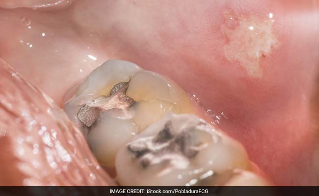 Dental Fillings Raise Mercury Levels In Body: Study