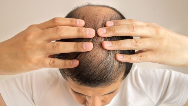 What are some causes of hair loss in men?