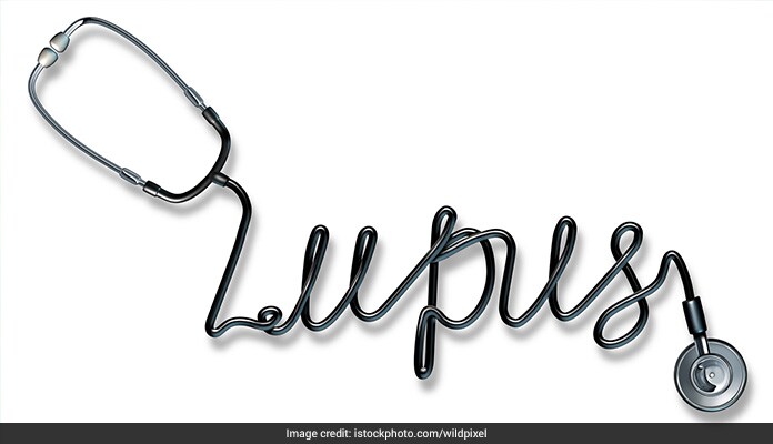 Things You Need To Know About Lupus