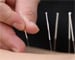 Acupuncture helps ease hot flashes in cancer treatment