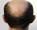 Baldness drug linked to sexual problems