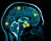 Brain scans help identify ADHD