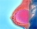 Breast reconstruction doesn't boost well-being