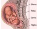 Who are more prone to breech births?