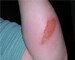 Protecting children from burn injuries