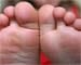 Diabetic foot ulcers linked to early death