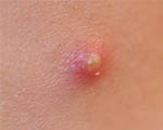 Severe acne may raise suicide risk