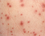 Allergies In Children