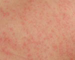 Does Your Child Have Any Allergies?