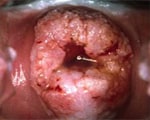 Anal HPV infection common in heterosexual men