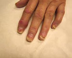 Obesity raises arthritis risk in psoriasis