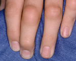 Social stress influences skin inflammation