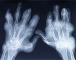 Better outcomes with early arthritis diagnosis
