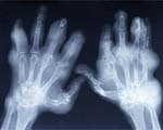 Better outcomes with early arthritis diagnosis Better outcomes with early arthritis diagnosis