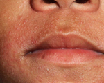 Allergic skin condition and cancer