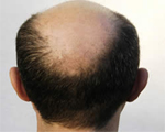 Baldness drug linked to sexual problems