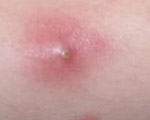 Home care for boils