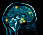 Brain scans help identify ADHD