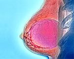 Exercise, green tea benefits breast cancer survivors