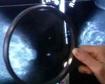 Breast abscess linked to smoking and nipple piercing
