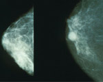 Sexual problems in women after breast cancer
