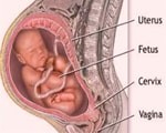 Who are more prone to breech births? Who are more prone to breech births?