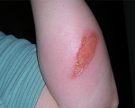 Protecting children from burn injuries
