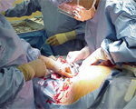 Stitches or staples fare equal after c-section