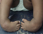 Treating clubfoot