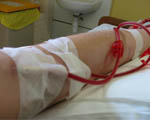 Risks for early dialysis