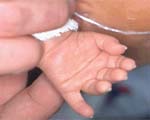 More Down syndrome as moms' age