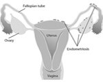 Chinese herbs for endometriosis Chinese herbs for endometriosis