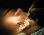 Eye surgery benefits patients with facial paralysis
