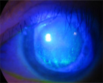 Sleep apnoea linked to eyelid disorder