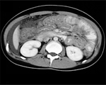 Gastroenteritis boosts bowel disease risk
