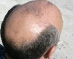 Hair loss signals prostate cancer risk Hair loss signals prostate cancer risk