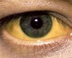 Common symptoms of jaundice 