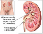 Kidney stones linked to clogged arteries