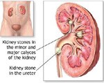 Kidney stones linked to clogged arteries
