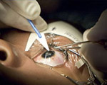 LASIK Surgery - the facts