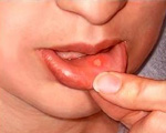 Preventing mouth ulcers