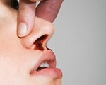 Causes of nosebleed Causes of nosebleed