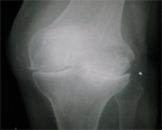 Weight gain common after knee replacement
