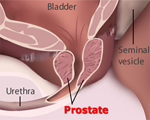 Prostate size doesn't affect surgery results