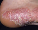 Preventing psoriasis