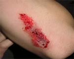 Skin bacteria aid healing