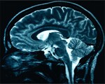 Stroke patients regain function at home Stroke patients regain function at home