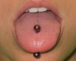 Metal tongue piercings linked to infection risks
